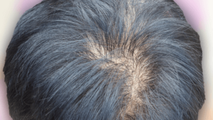 alopecia androgenetica