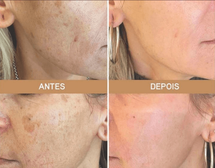 Resveratrol Para Pele Antes E Depois